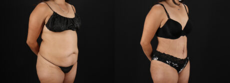 Tummy Tuck case #7461