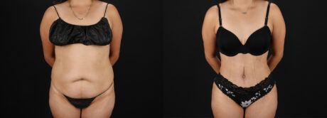 Tummy Tuck case #7461