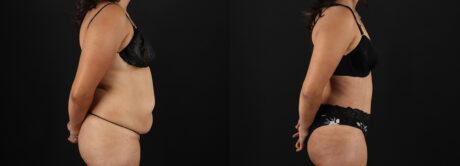 Tummy Tuck case #7461