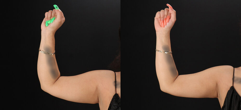 Brazilian Butt Lift case #5270