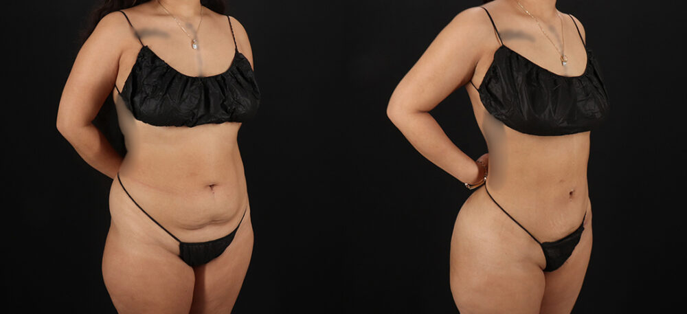 Brazilian Butt Lift case #5270