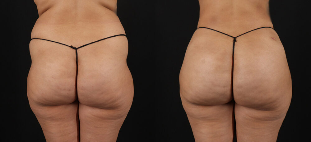 Brazilian Butt Lift case #5270