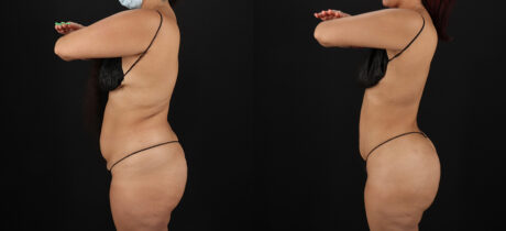 Brazilian Butt Lift case #5270