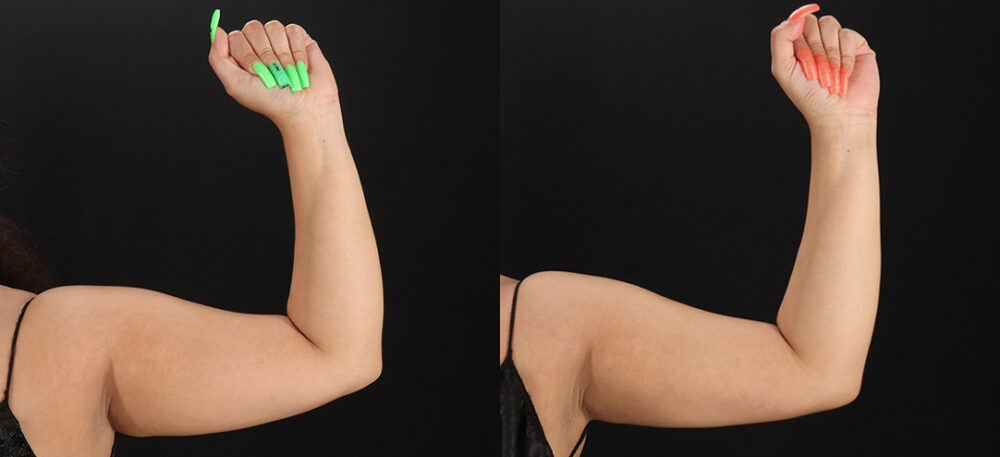 Brazilian Butt Lift case #5270