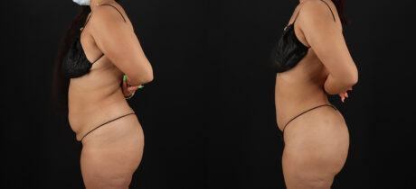 Brazilian Butt Lift case #5270