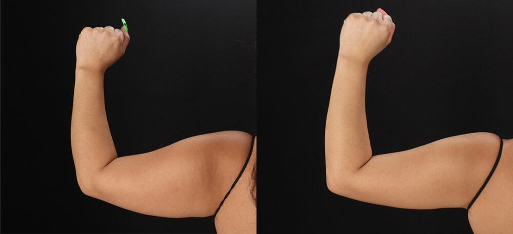 Brazilian Butt Lift case #5270