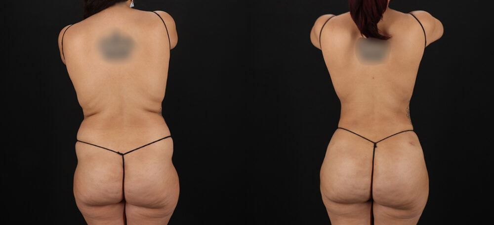 Brazilian Butt Lift case #5270