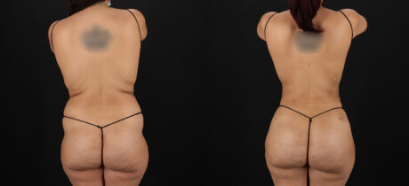 Brazilian Butt Lift case #5270