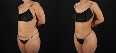 Brazilian Butt Lift case #5270