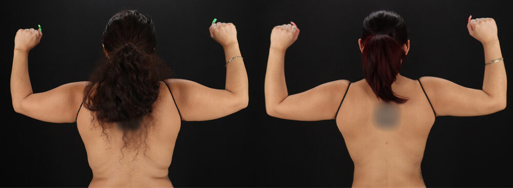 Brazilian Butt Lift case #5270