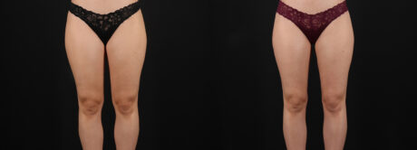 Liposuction case #6114