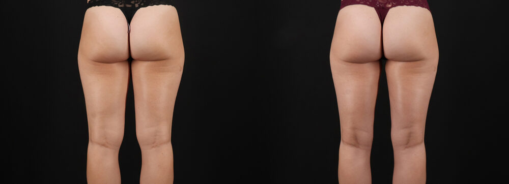 Liposuction case #6114