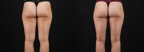 Liposuction case #6114