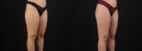 Liposuction case #6114