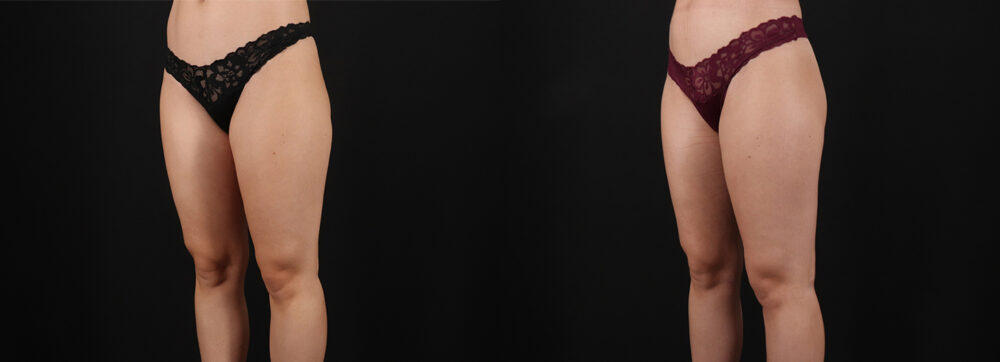 Liposuction case #6114