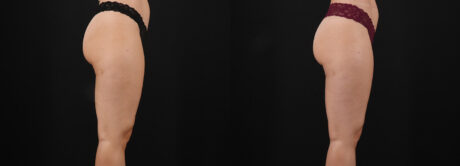 Liposuction case #6114