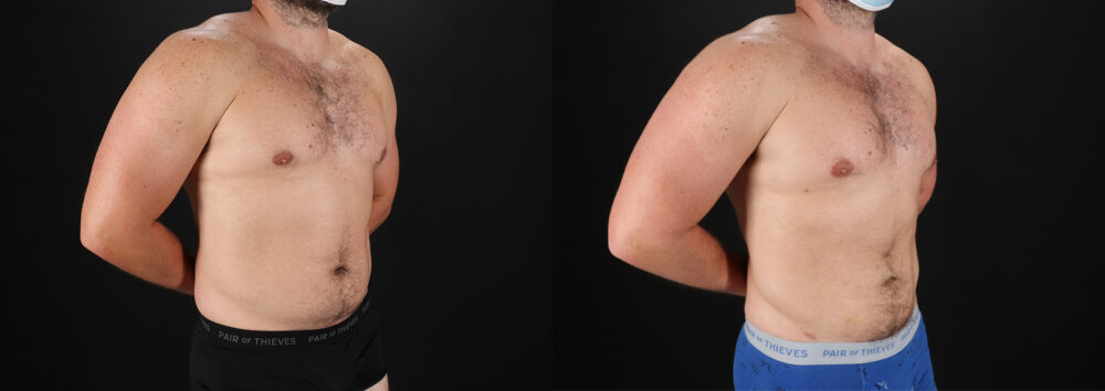 Liposuction case #6113