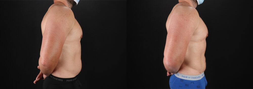 Liposuction case #6113