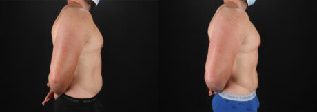 Liposuction case #6113