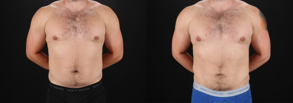 Liposuction case #6113