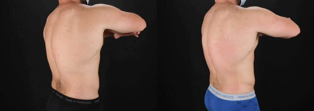 Liposuction case #6113