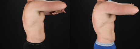 Liposuction case #6113