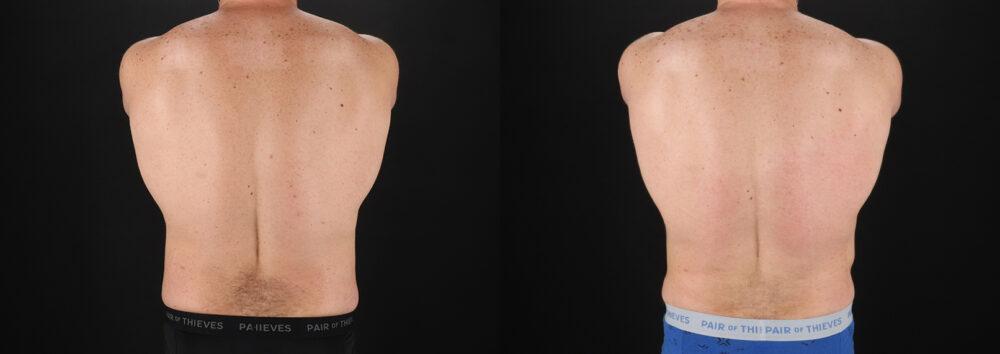 Liposuction case #6113