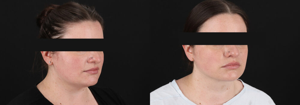 Submental Liposuction case #6954