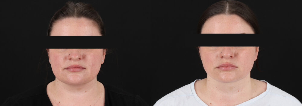 Submental Liposuction case #6954