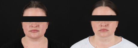 Submental Liposuction case #6954