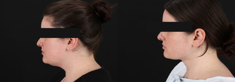 Submental Liposuction case #6954