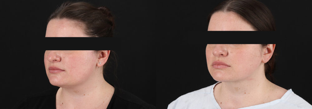 Submental Liposuction case #6954