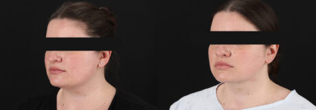 Submental Liposuction case #6954