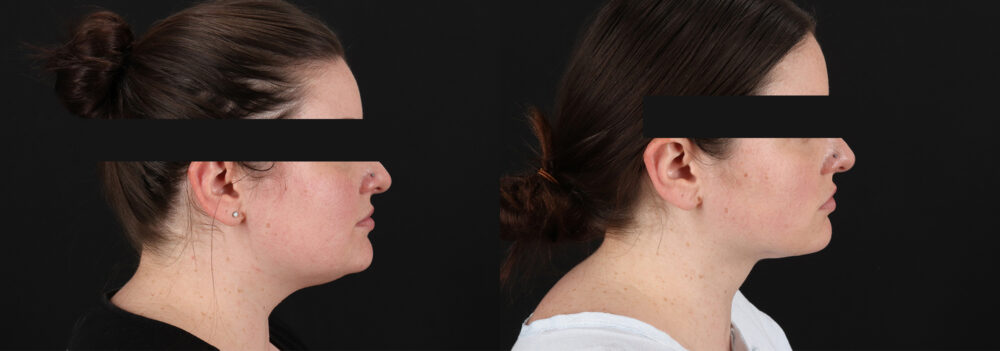 Submental Liposuction case #6954