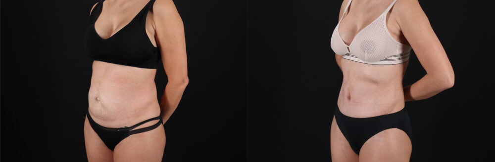 Tummy Tuck case #7463