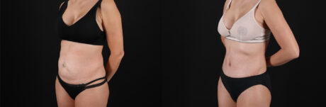 Tummy Tuck case #7463