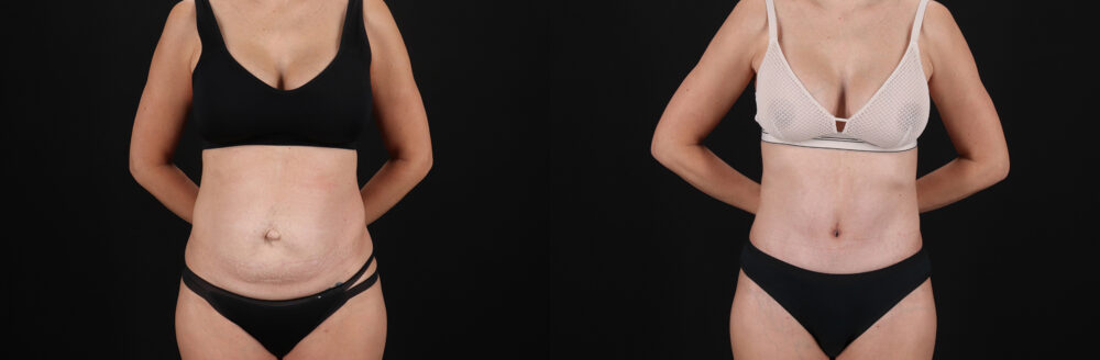 Tummy Tuck case #7463