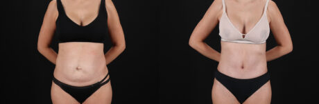 Tummy Tuck case #7463