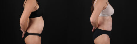 Tummy Tuck case #7463