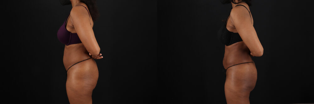 Liposuction case #6118