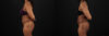 Liposuction case #6118 slider thumbnail