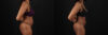 Liposuction case #6118 slider thumbnail