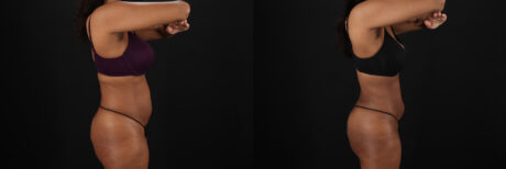 Liposuction case #6118