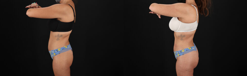 Brazilian Butt Lift case #5272