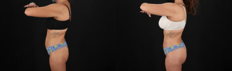 Brazilian Butt Lift case #5272