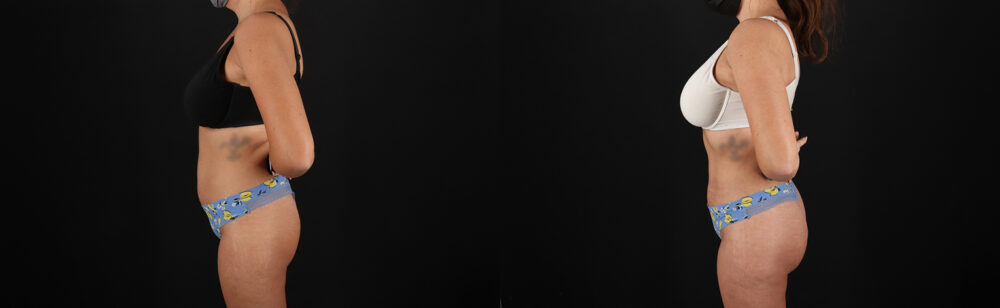 Brazilian Butt Lift case #5272