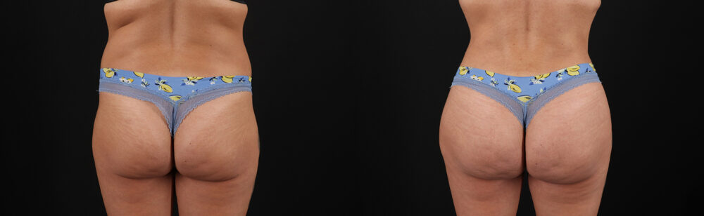 Brazilian Butt Lift case #5272