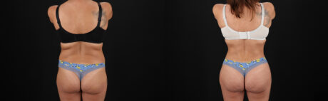 Brazilian Butt Lift case #5272