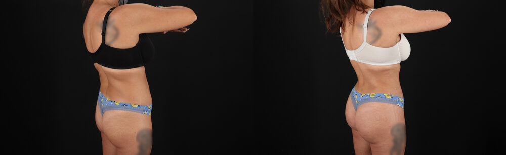 Brazilian Butt Lift case #5272