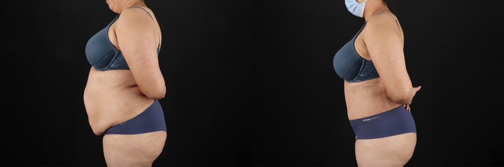 Tummy Tuck case #7464